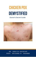 Chickenpox_Demystified__Doctor_s_Secret_Guide